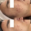 매탄동 196-매탄동111 | [수원여드름관리] 권선구 호매실 에스테틱 압출 여드름 임상 후기