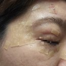 안성한의원 | [평택 용이동]평택안성 편평사마귀 얼굴부위 가성비 제거 한의원 내돈내산 찐후기