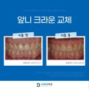 영광치과기공소 | 앞니크라운과 라미네이트 차이점은? (feat. 치료비용공개)