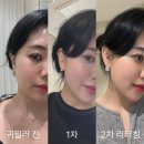 팅커벨 | 귀필러 후기 요정,팅커벨 귀필러 누운귀 2차 리터칭 대만족