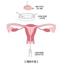 체외수정 In vitro fertilization 이미지