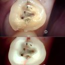 [김포 디얼유치과] 어금니가 찌릿! 씹을 때마다 아픈 '치아 균열', 결국 발치 후 임플란트 한 사연