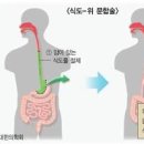 식도암 초기증상 예방법까지 이미지