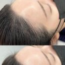 선헤어라인 이미지