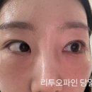 교촌치킨압구정 | 압구정피부과 리투오파인 눈밑 효과 일주일 후기 (눈밑꺼짐 리투오파인 내돈내산)