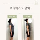 서울운동교정센터 | 허리디스크도 운동해도 될까요? 스웨이백 자세와 허리...서울숲 체형교정 운동센터 반듯한일상 실제 후기