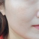 제1종근린생활시설 (이성우) | 수원피부과) 피코토닝 레이저 시술 받은 후기+5일경과
