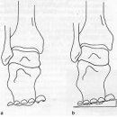 제1장 발보조기(foot orthoses)의 개요 - 2. 발 보조기(foot orthosis)의 분류 - 2.3 형태에 따른 분류 이미지