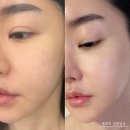 하남 미사역 피부과 물광주사 스킨부스터 릴리이드M 시술 후기!