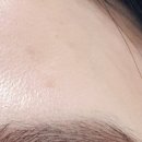 아임스타의원 | 얼굴 쥐젖 제거 후기사진 수원 아임스타의원