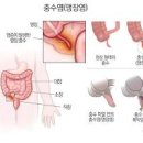 여자 오른쪽 아랫배 통증 원인 정리 이미지