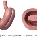 복강경하 위대만 주름술[Laparoscopic Greater Curvature Plication(LGCP)] 이미지