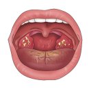 편도선염(Tonsillitis) 이미지