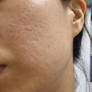 수복한의원 | 창원 한의원, 새살침으로 여드름 흉터 모공치료 받은 후기