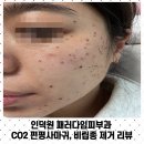 패러다임피부과의원 | 인덕원 패러다임피부과 CO2 편평사마귀, 비립종 제거 리뷰