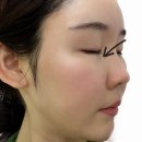 도움의원 | * 자연스럽게 볼륨 채우고 싶어서 울트라콜 받았어요 (눈밑꺼짐 개선 후기) 블루미의원