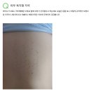 백신 접종자들 피부에 &#39;육각 모양&#39;의 발진이 나타나고 있다/ 접종자 피부 마크는 5G 무선 안테나? 이미지