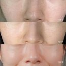 (주)코리아메디칼디바이스 | 장나라 풀텐자 모공디바이스 화이트헤드 관리 2달 차 후기