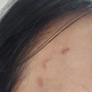 제네시스테라피 | 550 피부과 패키지 관리 5회차 | 피코토닝 + 제네시스 후기