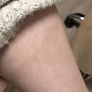 베스티안 편의점 | 끓는 물 화상 당하고 2년이 지난 지금