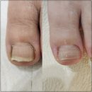 안성면105 | [무주 | 풋&amp;네일 페디크루]안성면내성발톱 부남면내성발톱