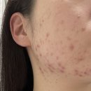 김정문알로에 | 김정문 알로에 큐어크림 후기 화농성,좁쌀 동시에 올라왔을 때