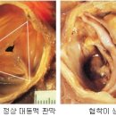 대동맥 판막 협착증 치료 가이드라인 - 아산병원 심장내과 강덕현 교수(편집) 이미지