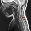 급성 횡단성 척수염[acute transverse myelitis, ATM] 이미지