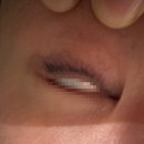 삼원약국 | 강남 수아미! 점막 아이라인문신제거 2차 비교, 평점, 결과 후기