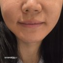 오른외과의원 | 강남역 피부과 소프웨이브 얼지흡 후 관리 레이저 잔주름 다림질 하고옴