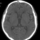 치매- 증례들 이미지