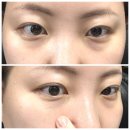 만곡 | 비중격만곡증 부비동염 하비갑개 축소술 수술 후기