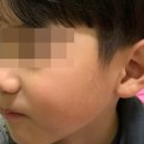 노니살롱 | 효과없던 모공각화증 닭살피부엔 알레 포뮬러로 해결