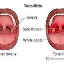 편도선염 / 급성 편도염 및 원인, (전염, 약, ) 이미지