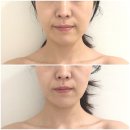 끌리메 | 부산 해운대 센텀 피부관리 얼굴라인 고민 끌리메 센텀점 끌링관리 후기