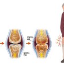 연령별 무릎통증 60대 이상의 무릎 이미지