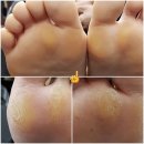 루덴네일