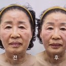 [대구 북구] 대구윤곽리프팅 널 위한 뷰티 알테온 관리 후기