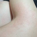 만성 | [졸레어 1차 후기] 만성 두드러기, 비만세포증