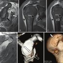 습관성 어깨탈골 재발 및 반복되는 원인 및 증상 어깨 탈구 관련한 어깨 관절경 수술 정보 이미지