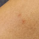 삼일세탁소 | 진드기 물린자국이 안 없어져요.. 침대 속 원인부터 제거법까지