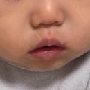 바나나성형외과의원 | 16개월 아기 침대 낙상 입술 상순소대 찢어짐 소아치과