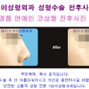 대구코성형수술 후 상처소독과 실밥제거는 언제쯤?[대구성형외과,대구안면윤곽술] 이미지