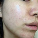이소한의원 | 4년 여드름 치료 후 결국 복용한 이소티논 후기｜처방부터 가격, 복용법, 부작용까지