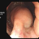 위장관 간질종양(GIST), 유암종(carcinoid tumor), 악성 림프종등의 대장암 이미지