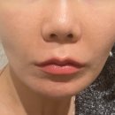 생각하는광고 | 팔자주름 필러 내돈내산 후기 광고에 속지 않고 제대로 보는 방법