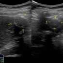 Hepatic isoechoic lesion with echogenic band?? (궁금합니다.) 이미지