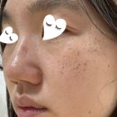 갤러리의원 | 압구정 [루나의원] 루비레이저 후기와 관리팁★