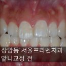 서울프리벤치과의원 네이버블로그