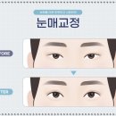 자신감을 더하는 수원성형외과 수원하안검수술